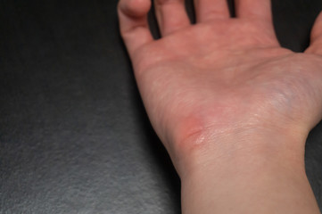 Fototapeta premium Asian massaging painful hand with Arthritis and office syndrome concept indoor