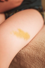 Large bruise of a yellow hematoma on the thigh - severe bruise