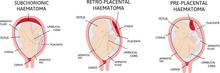 Placental haematoma. blood clots that arise from the placenta. - obrazy, fototapety, plakaty