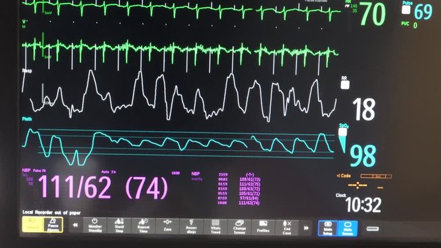 Close up view of a colorful vital signs display in a hospital showing active tracings of an EKG, respiration, and pulse rate  