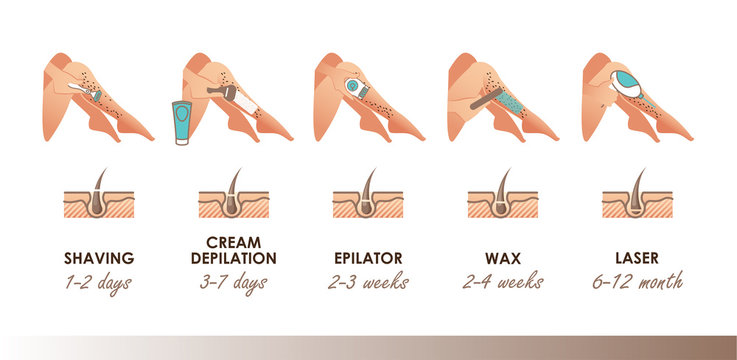 Different methods of hair removal. Shaver, depilatory cream, epilator, wax and laser. Types of epilation with timeline actions