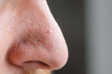 Clogged pores. Problematic skin. Post-acne, scars and red festering pimples on the face of a young...