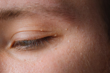 Fototapeta na wymiar Milia (Milium) - pimples around eye on skin. Eyes of young man with small papillomas on eyelids or growths on skin