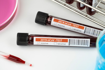 Test tube with blood sample in lab for COVID-19 test, laboratory sample of blood testing for diagnosis new Corona virus infection, novel corona virus 2019 the pandemic infectious concept