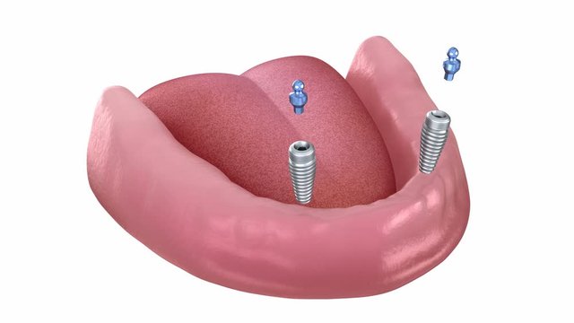 Mandibular removable prosthesis All on 2 system supported by implants with ball attachments. Medically accurate dental 3D animation.