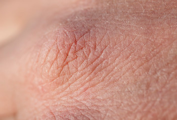 background with the texture of pink weathered human hand skin covered with deep wrinkles and dry scales and cracks