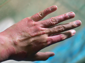 Fototapeta premium A man with psoriasis on his hand. Very bad case.
