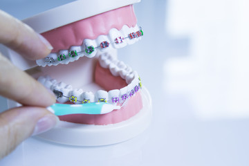 Model denture with metal orthodontics