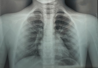 X ray of chest and lungs of young boy. Concept complications from coronavirus, pneumonia