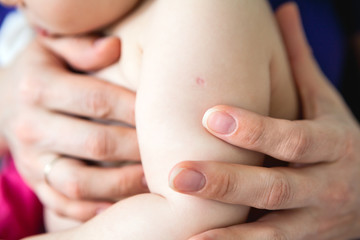 BCG vaccination mark is on infant shoulder, close up view with mother hands