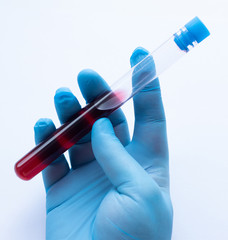 A doctor in disposable latex gloves holds a test tube with a blood sample.