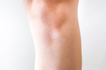Fototapeta na wymiar White vitiligo spot on the skin, lack of melanin
