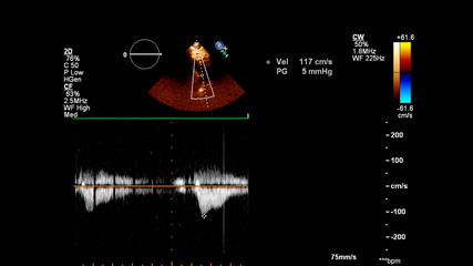Image of the heart during transesophageal ultrasound with Doppler mode.