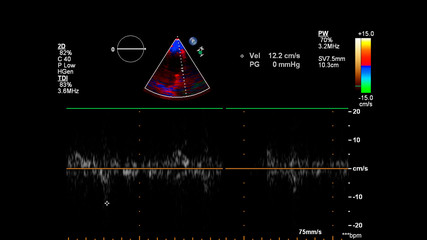 Image of the heart during transesophageal ultrasound with Doppler mode.