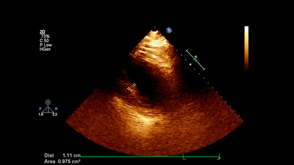 Image of the heart in gray-scale mode during transesophageal ultrasound.