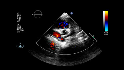 Image of the heart during transesophageal ultrasound with Doppler mode.