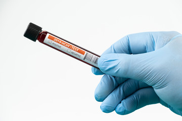 Obraz premium Test tube with blood sample in lab for COVID-19 test in hand of doctor wear blue glove, laboratory sample of blood testing for diagnosis new Corona virus infection, the pandemic infectious concept