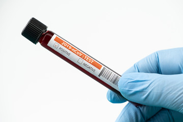 Obraz premium Test tube with blood sample in lab for COVID-19 test in hand of doctor wear blue glove, laboratory sample of blood testing for diagnosis new Corona virus infection, the pandemic infectious concept
