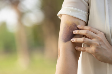Sad asian female people showing a bruise in her arm,woman has bruises all over her body,caused by...
