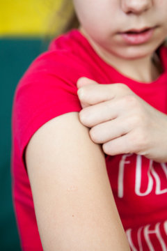 Smallpox is on human shoulder following BCG vaccination against TB vaccine