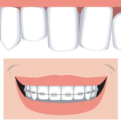 Molars and incisors with braces on the upper jaw healthy smile, flat vector stock illustration with teeth and as a concept of orthodontic services