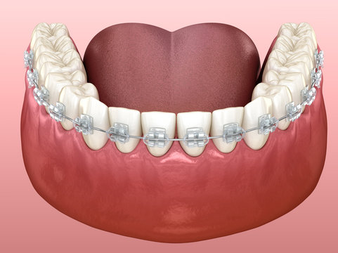 Mandibular jaw and Clear braces. Medically accurate dental 3D illustration