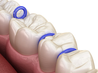Rubber separator between teeth, preparation for braces placement. Medically accurate dental 3D illustration