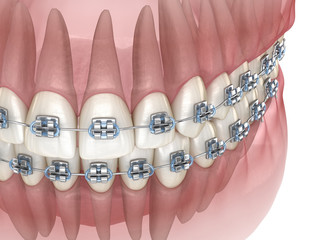 Metal braces and transparent dental model. Medically accurate 3D illustration