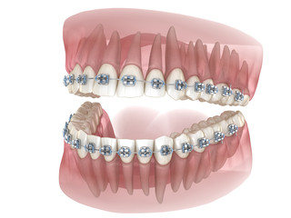 Metal braces and transparent dental model. Medically accurate 3D illustration