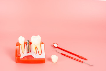Example of Implants and dental tools for use in explaining.