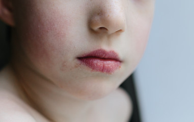 Herpes on lips of child. Clouse up lips