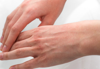 Fototapeta na wymiar Hands with dry, irritated, and cracked skin