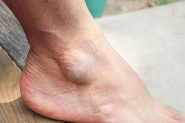 Naklejka premium close up men rough right ankle