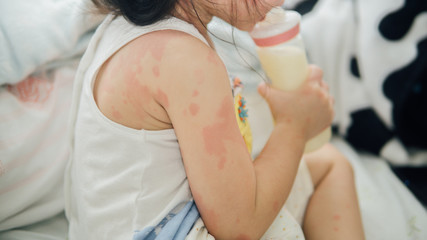 Obraz na płótnie Canvas Asian girl with rash from milk allergy.