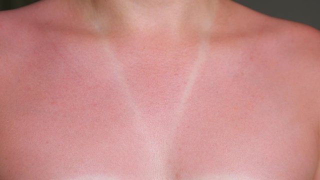 young woman sunburned bare chest and neck with red suntan around white designed swimsuit imprint close-up