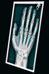 Röntgen Hand 3D
