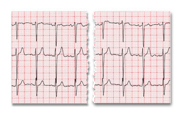 Cardiogram. The result of research CU is torn in half.
