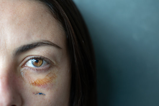 Closed Up Shot Showing A Battered Woman's Eye. Injuries To Her Face From Assaults Are Healing. Fight Against This Scourge Of Society That Is Domestic Violence.Copy Space.Violence Concept