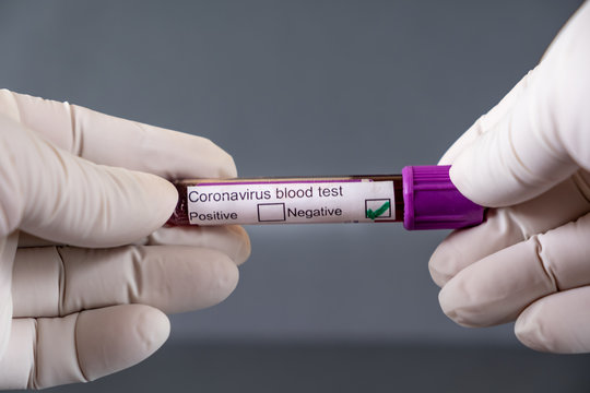 Corona virus Covid-19 blood test. Tube containing a blood sample that has tested negative for coronavirus.