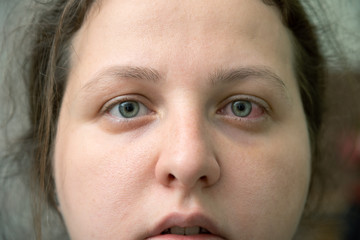 Closeup of irritated red bloodshot eye - conjunctivitis. one of the rare symptoms of coronavirus covid -19