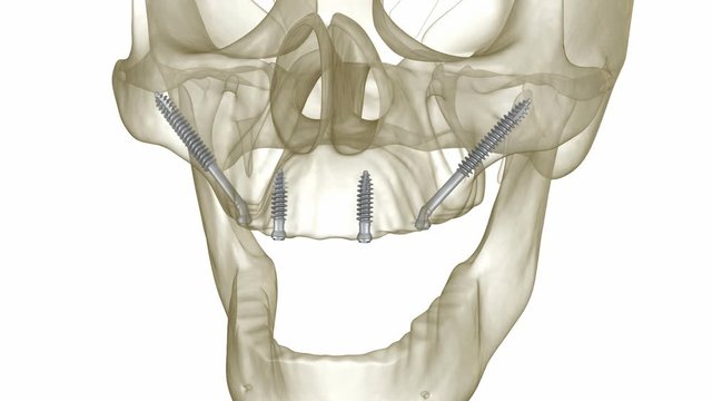 Maxillary prosthesis supported by zygomatic implants. Medically accurate 3D animation of human teeth and dentures