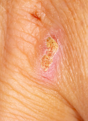 A wound from a knife cut on a person’s skin