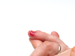 male toe with torn bleeding skin (fresh personal injury)
