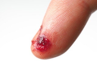 male toe with torn bleeding skin (fresh personal injury)
