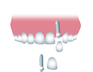 Tooth implant