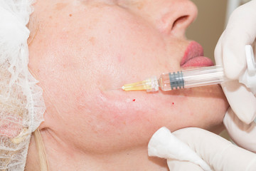 Cosmetic injection procedure in a beauty salon in the face of a woman of middle age.

