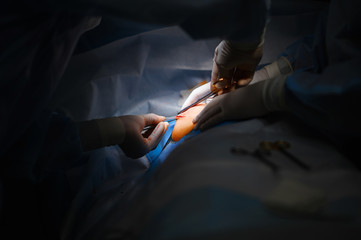 Breast tumor resection. Wound closure