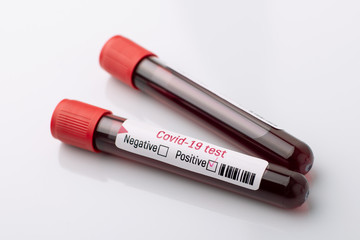 Positive COVID-19 test in laboratory. Testing blood on new coronavirus. Coronavirus outbreak.