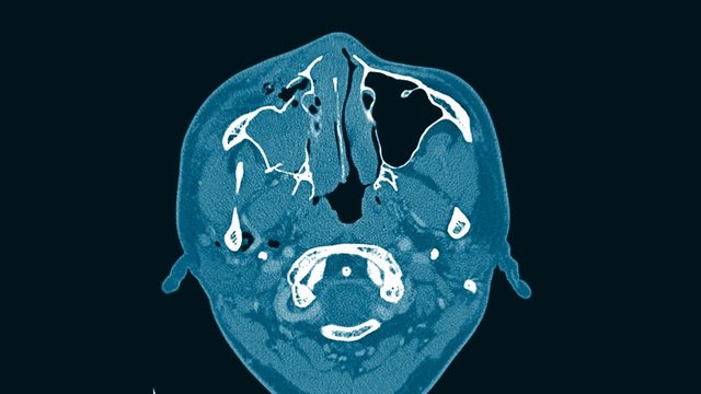 Computed tomography of the skull. Brain and orbit scan examination finding mass or tumor in side face.Blue tone process.