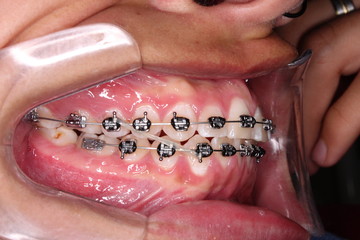 Class III Elastic